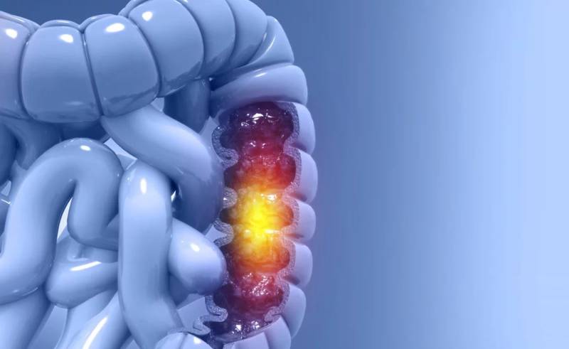 El cáncer de colón se hace presente con más frecuencia en los jóvenes que en los adultos | Foto: Referencial