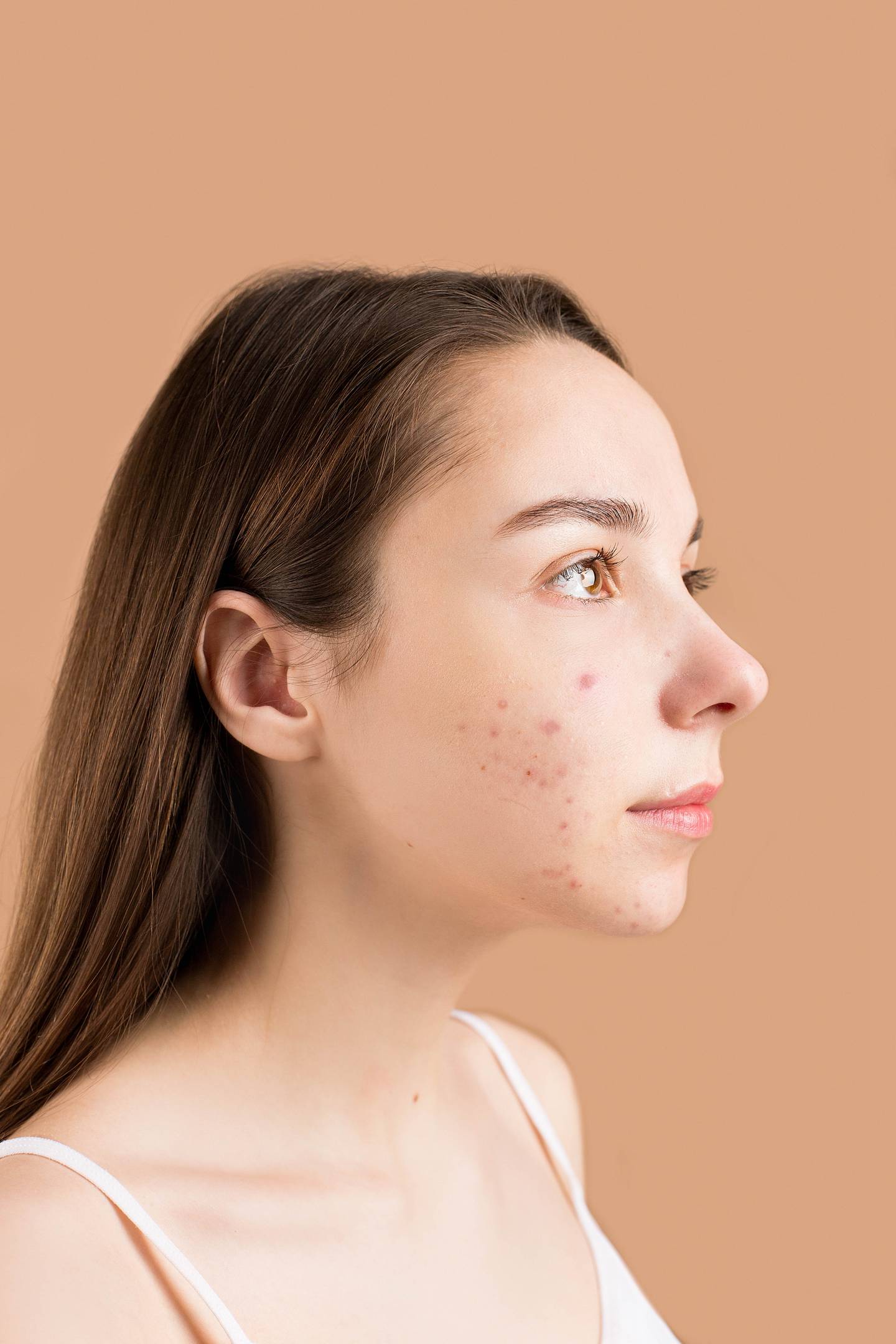 Cuidado para piel con acné
