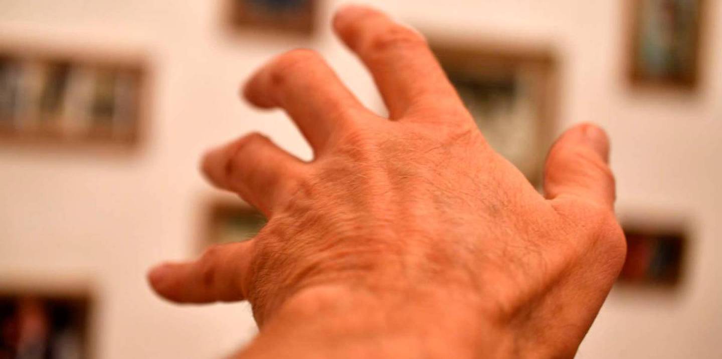 El Parkinson genera rigidez en las manos.