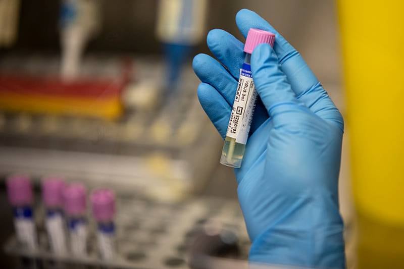 Un técnico de laboratorio médico muestra una muestra sospechosa de viruela del mono en el laboratorio de microbiología