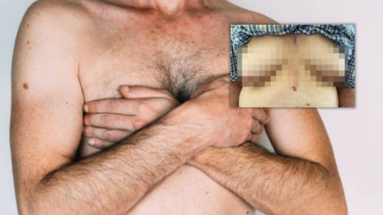 Medicamento para el corazón provocó crecimiento de senos en un hombre de 76 años