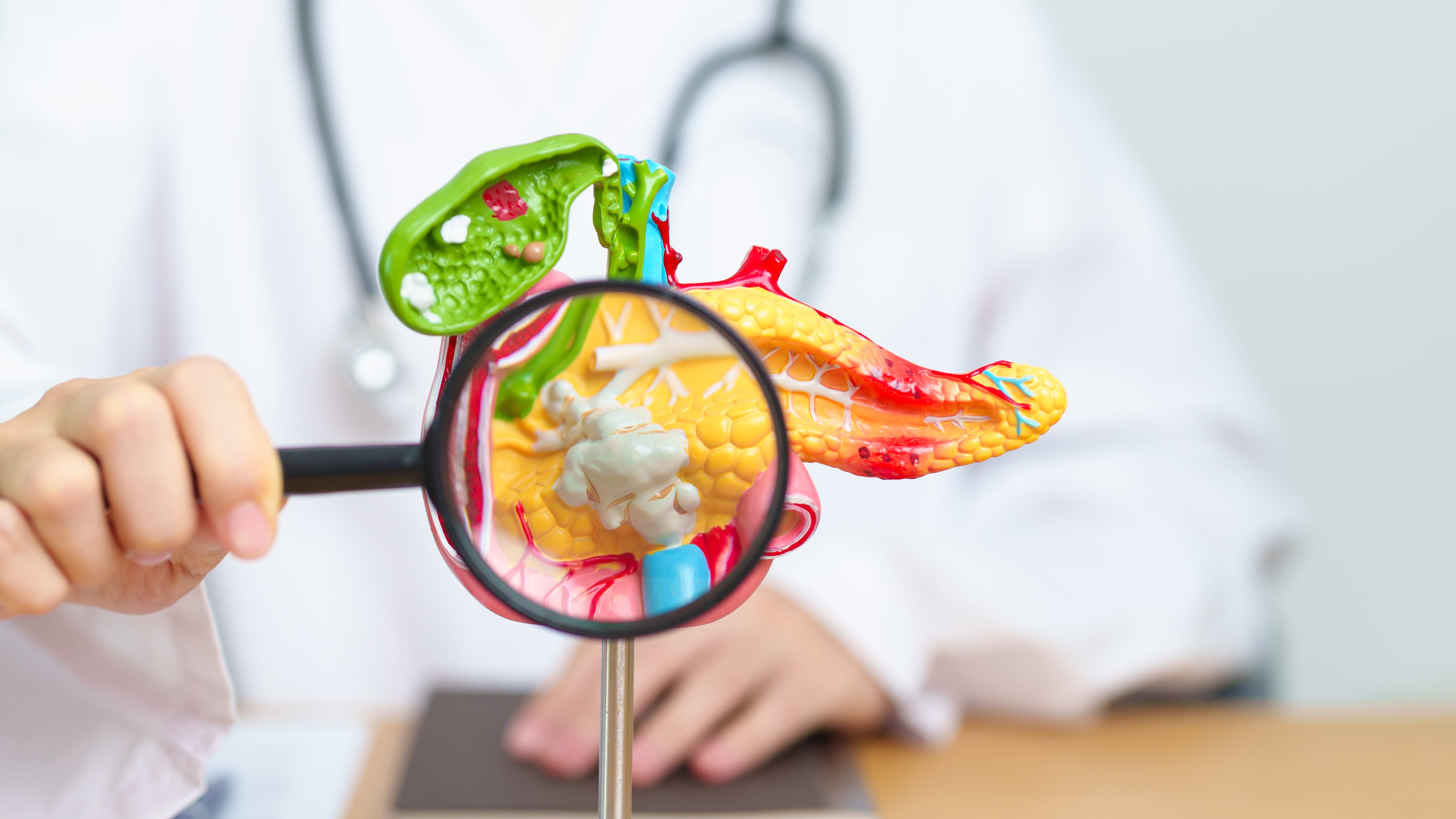 cáncer de páncreas suele detectarse en etapas avanzadas