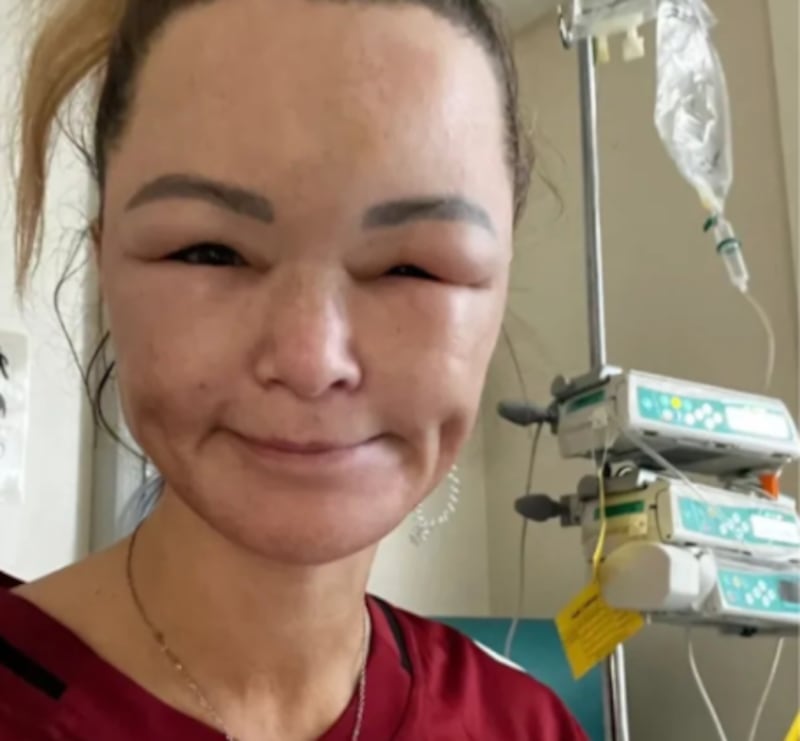 Profesora queda ciega y desfigurada tras accidente: no puede salir de su casa.