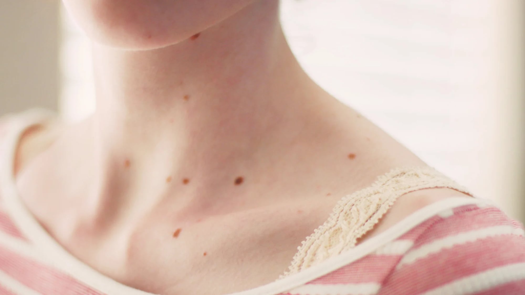 Presta atención a estos cambios en tu piel, podría ser cáncer