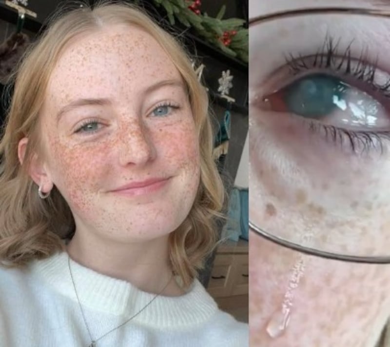 Se duchó con lentes de contacto durante sus vacaciones y esto pasó con su ojo