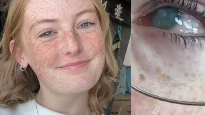 Se duchó con lentes de contacto durante sus vacaciones y esto pasó con su ojo