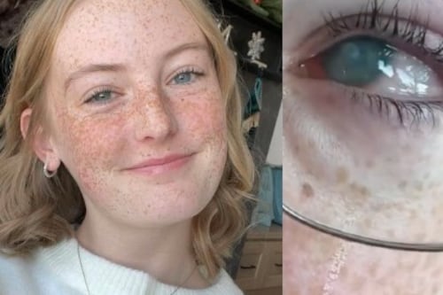 Se duchó con lentes de contacto durante sus vacaciones y esto pasó con su ojo