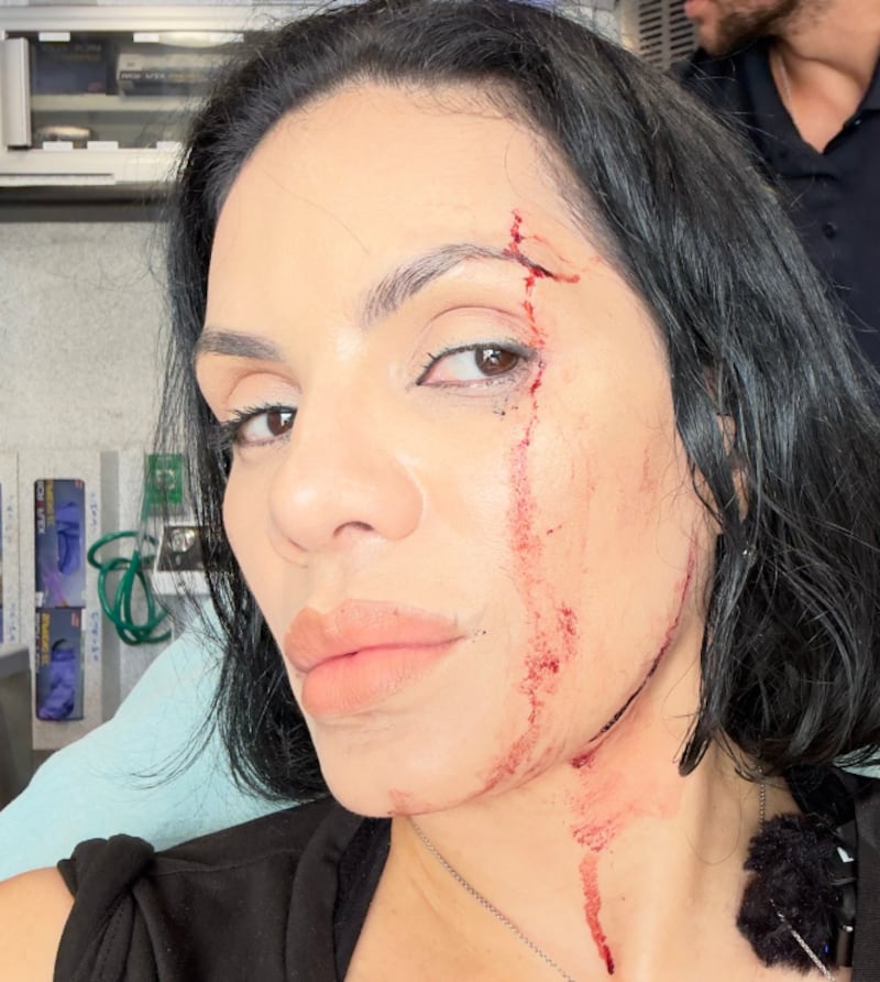 Heridas que influencers sufrieron