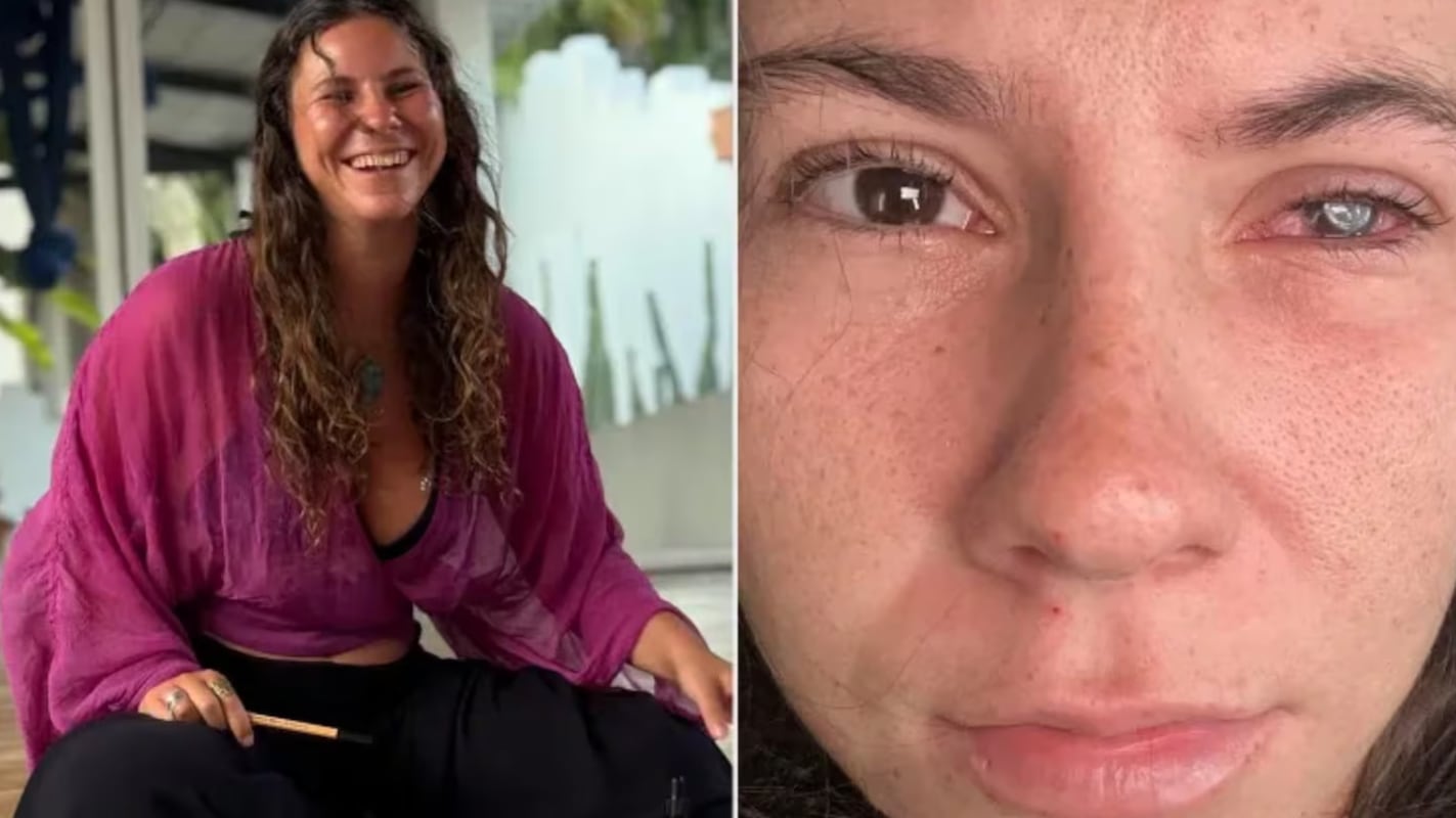 Tiktoker pierde la vista tras contraer un parásito que se alojó en su ojo