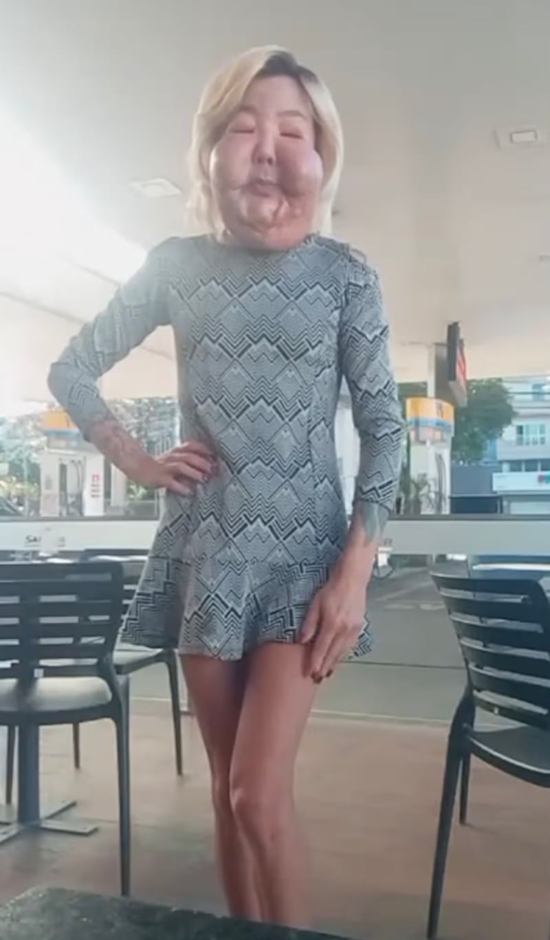 Influencer que quedó desfigurada tras cirugía fallida vuelve al quirófano para nueva intervención estética.