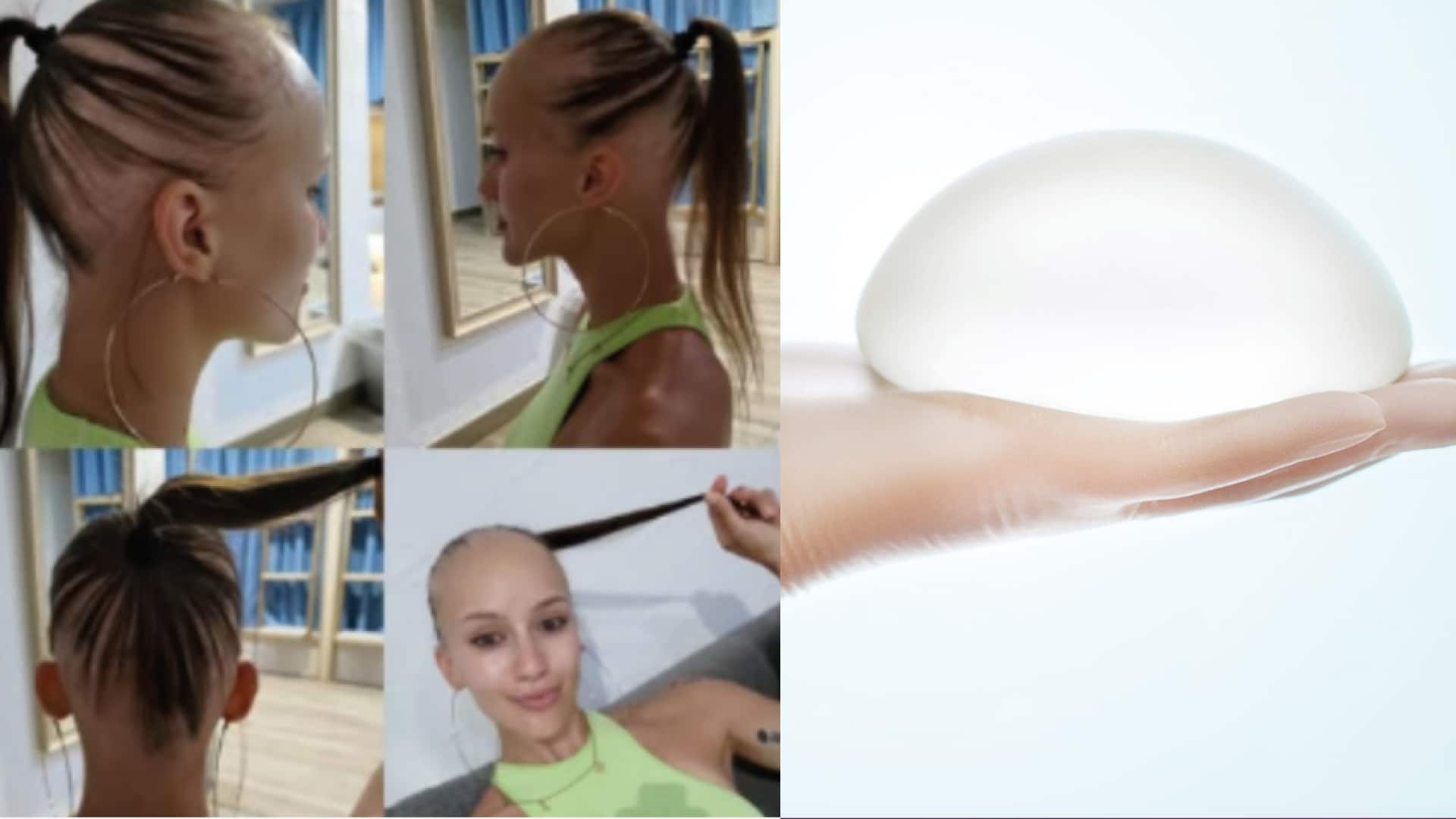 Una joven se operó el busto y se quedó sin cabello y pestañas ¿qué pasó?