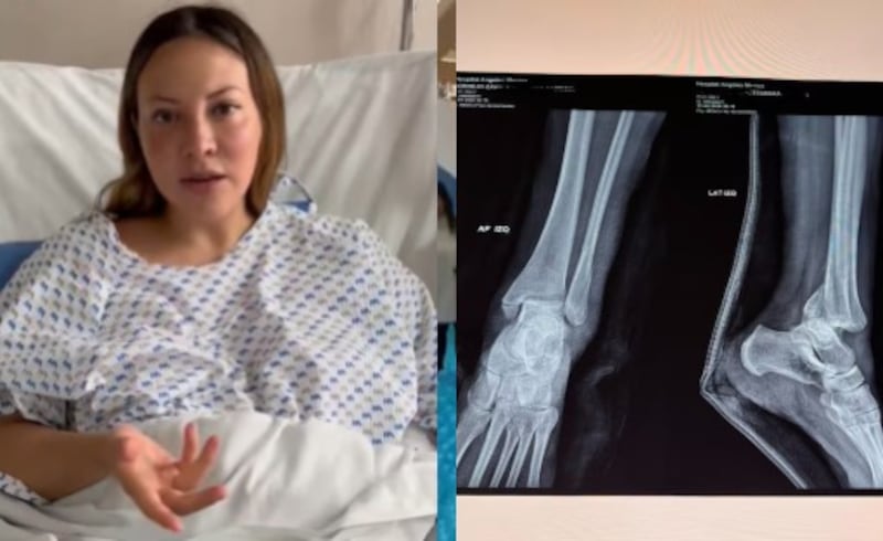 mujer sufrió tres fracturas tras un accidente en un juego infantil