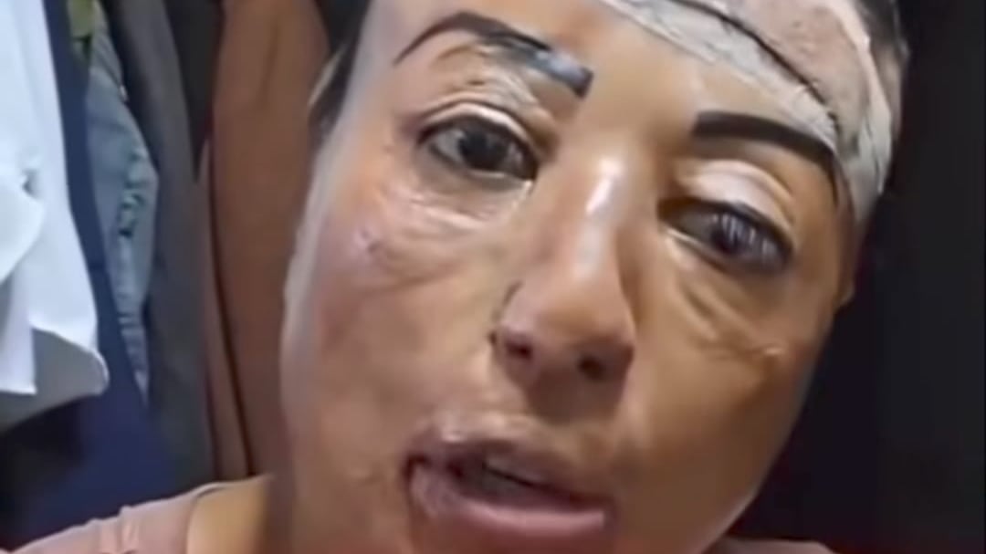 Mujer sobrevive a explosión de su celular mientras dormía