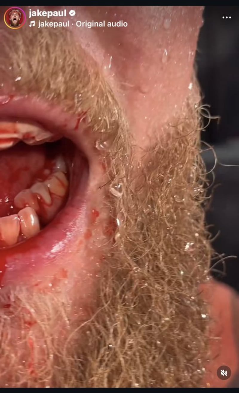 Lesión de Jake Paul.