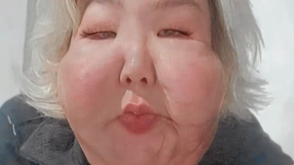 Influencer que quedó desfigurada tras cirugía fallida vuelve al quirófano para nueva intervención estética