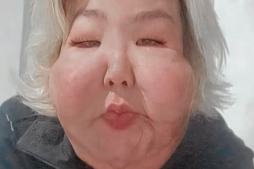 Influencer que quedó desfigurada tras cirugía fallida vuelve al quirófano para nueva intervención estética