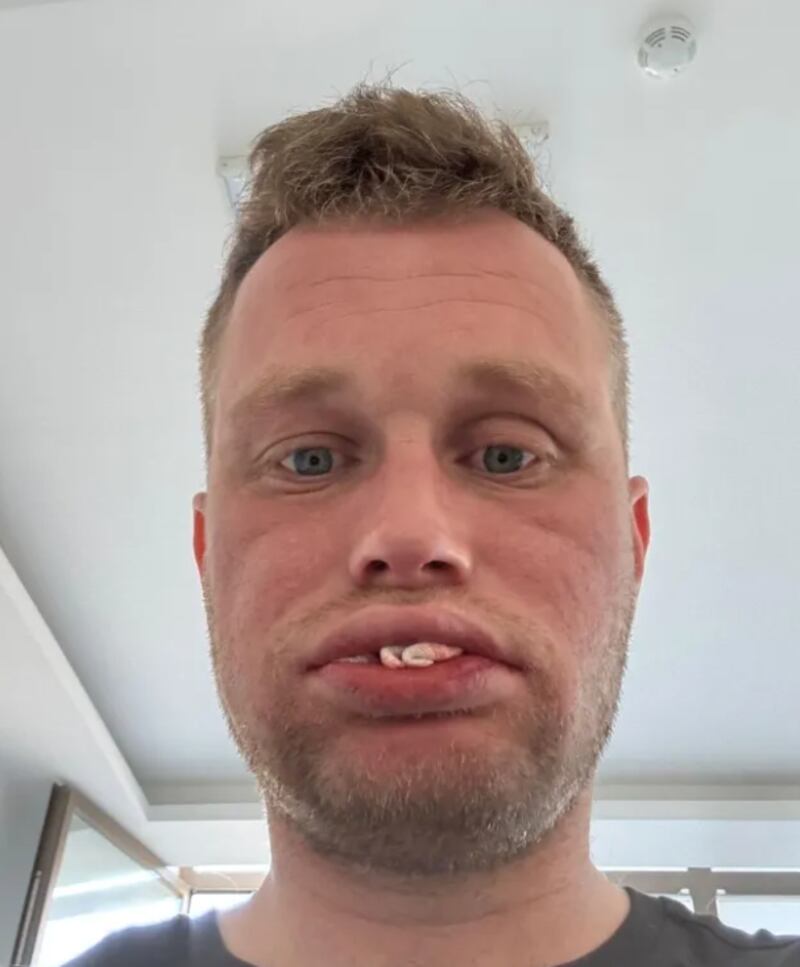 Viajó para arreglarse los dientes y terminó sin poder comer. Foto: The Sun