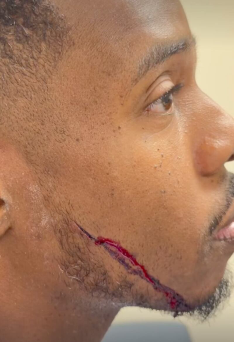Heridas que influencers sufrieron