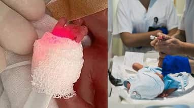 Bebé de 300 gramos sobrevive en hospital de Alemania