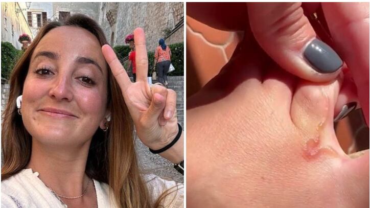 Un gusano vivo dentro del pie: así es la "larva migrans" que sufre una influencer