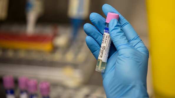 Un técnico de laboratorio médico muestra una muestra sospechosa de viruela del mono en el laboratorio de microbiología