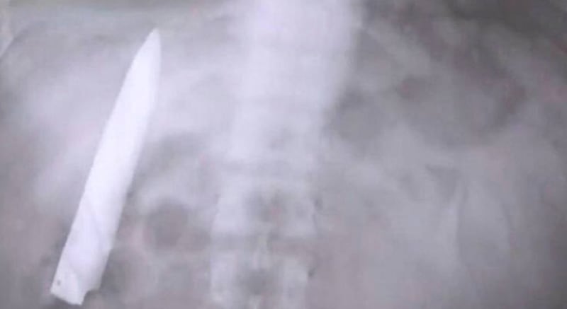 Insólito caso médico: cuchillo permanece ocho años en el pecho de un hombre en Tanzania.
