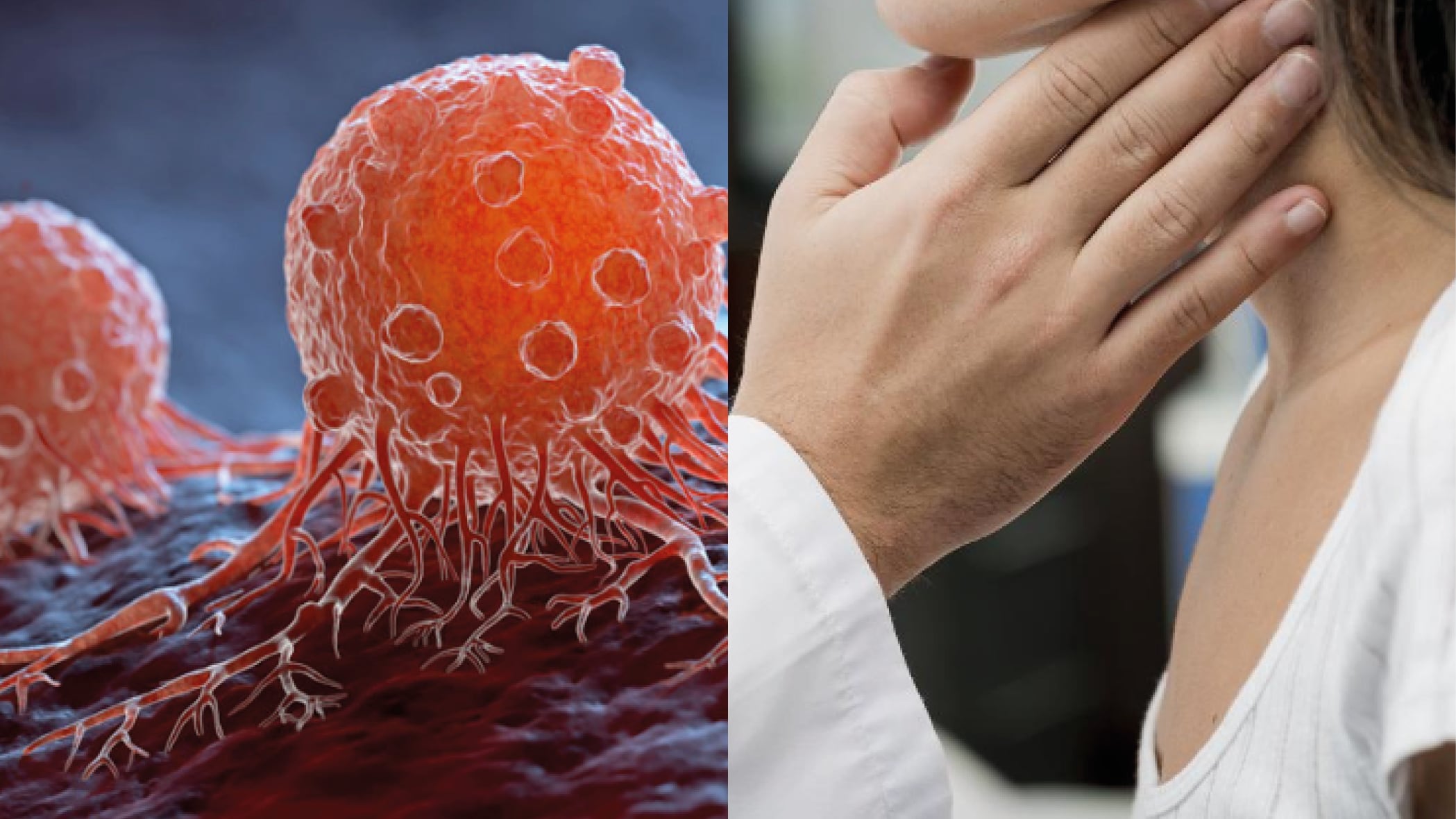 El cáncer entre adultos menores de 30 años en el mundo aumenta drásticamente, ¿a qué se debe?