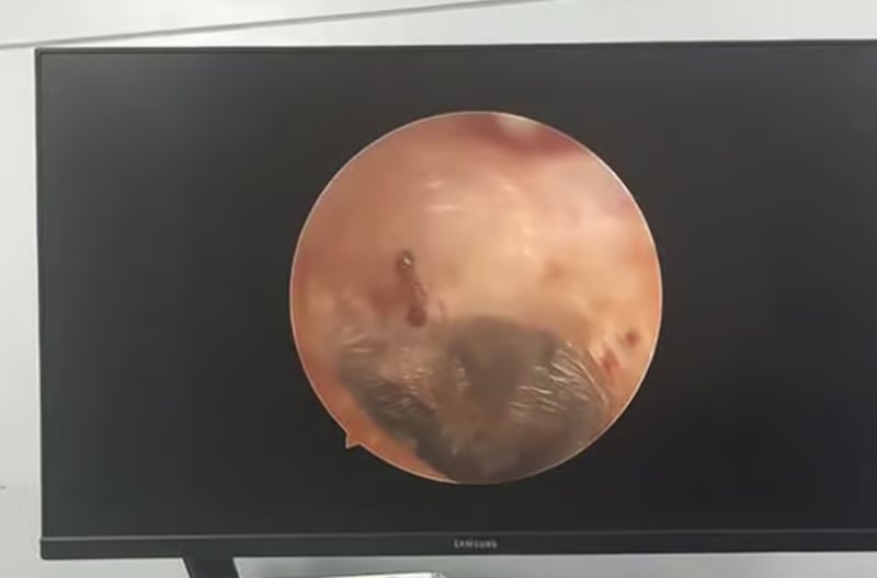 Mujer descubrió que tenía una hormiga en su oído tras escuchar ruidos extraños - Fuente: Foto de la web