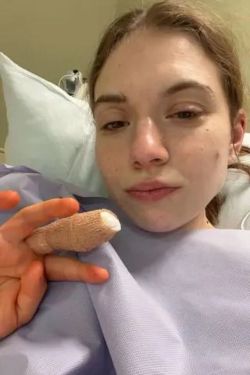 Hábito mortal: joven de 21 años estuvo a punto de perder un dedo por morderse las uñas - Fuente: Foto de la web