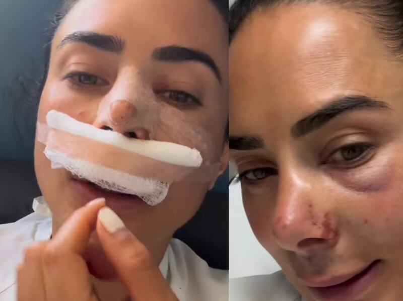 Johanna Fadul tuvo delicado accidente en medio de reality “se me salió un disco de la columna”