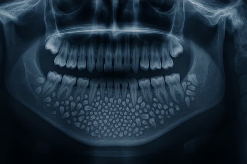 El increíble caso del niño al que le extrajeron 526 dientes en una cirugía