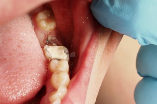 Problemas dentales que no sabías que podrían provocar un infarto