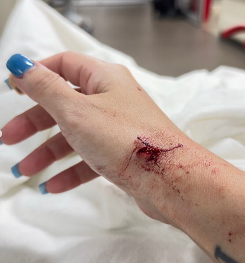 Heridas que influencers sufrieron