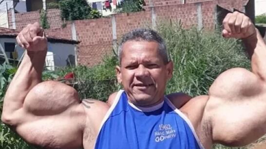 Fallece hombre que se inyectaba aceite mineral en los brazos, conocido como el Popeye Brasilero - Fuente: Foto de X