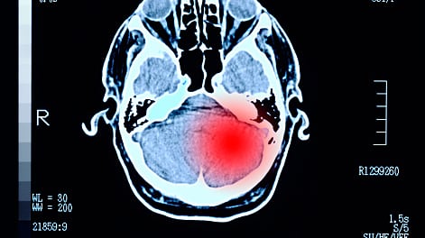 Fue al médico por un dolor de cabeza y le hallaron un tumor por el que le quedaban horas de vida