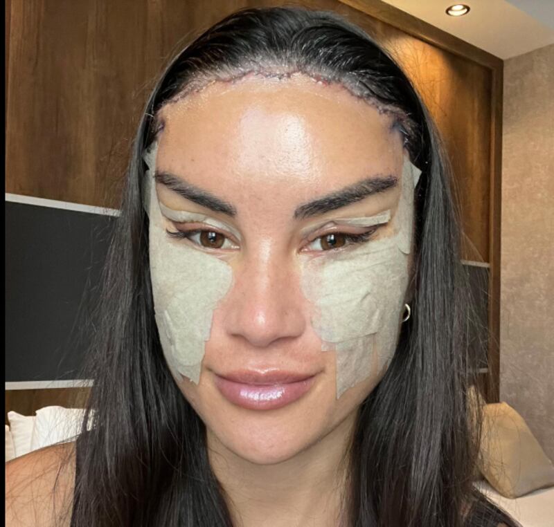 Lourissa Setu muestra los resultados de su mini lifting facial, reducción de frente y cirugía de ojos de zorro.