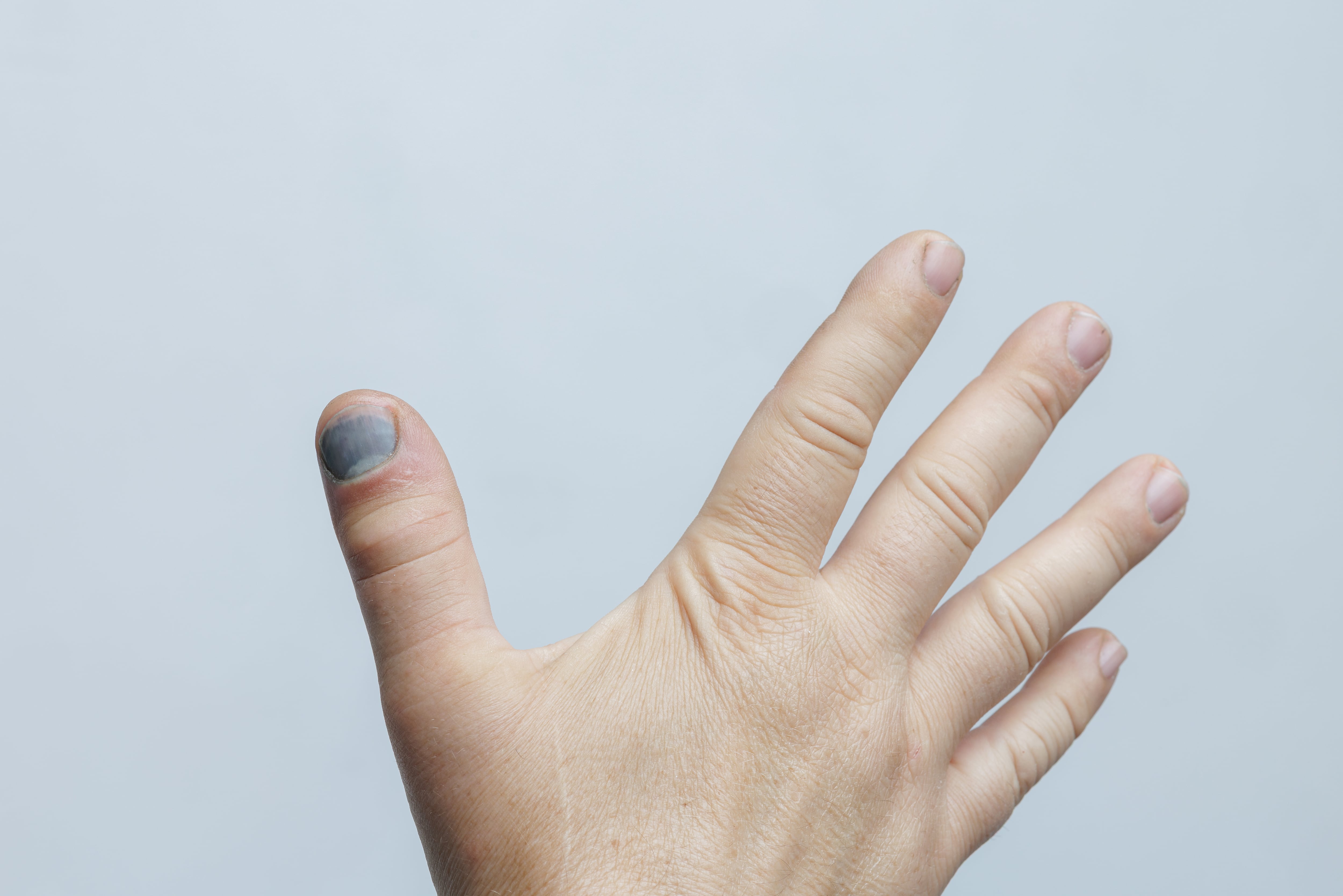 Expertos recomiendan consultar si las alteraciones en las uñas persisten.