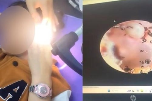 Una pequeña se quejaba de un dolor en el oído y los médicos le encontraron algo terrorífico