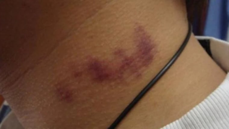 Adolescente pierde la vida tras recibir un “chupón” en el cuello