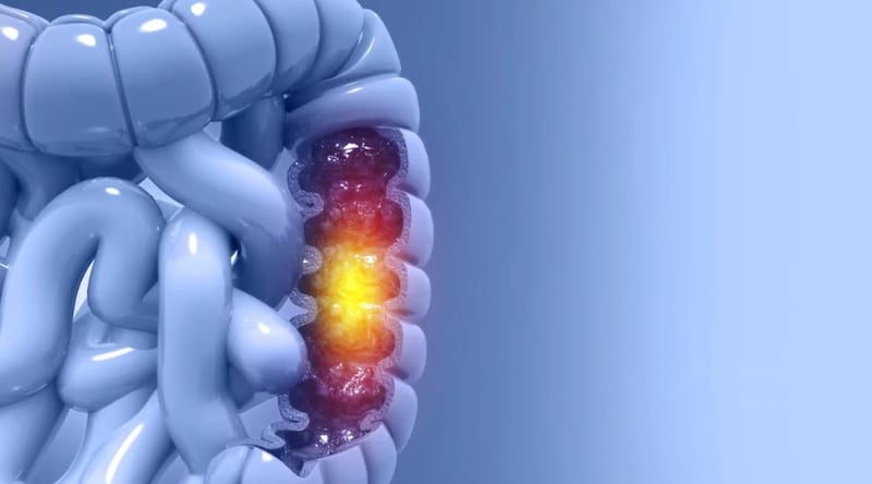 Cáncer de Cólon. | Foto: Referencial