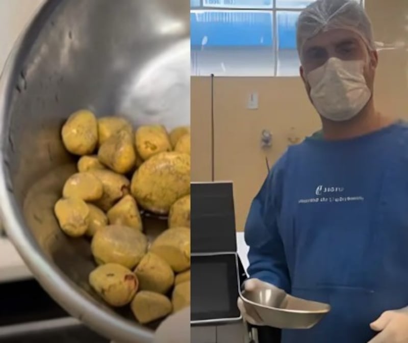 cálculos en la vejiga