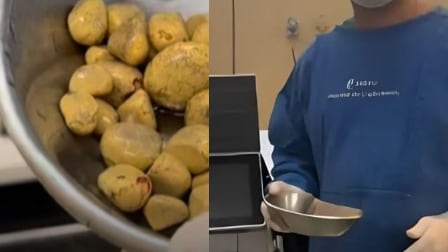 cálculos en la vejiga