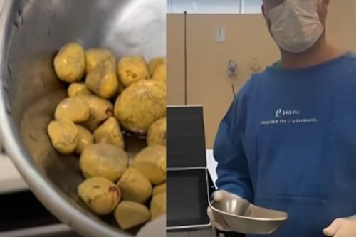 Lo que le encontraron a un hombre tras años de beber gaseosa sorprendió a médicos