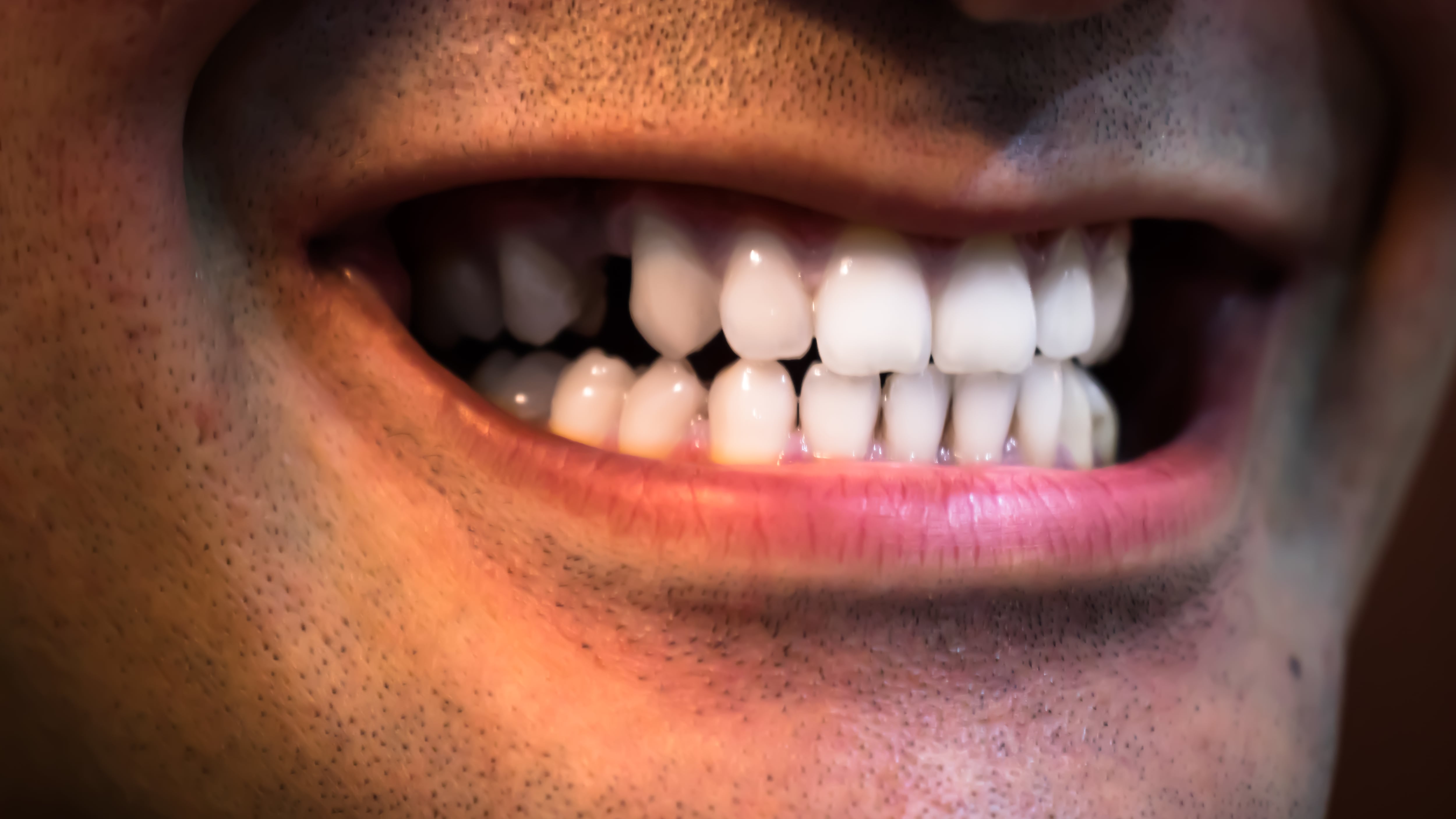 Primer plano de un hombre con la boca abierta que muestra dientes blancos