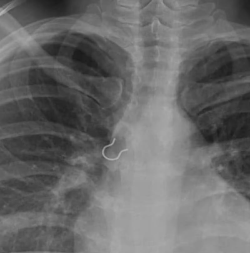 Mujer descubrió que había inhalado su propio piercing nasal tras sufrir una fuerte tos