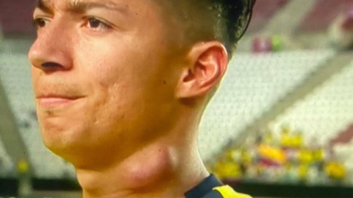 ¿Qué pasó en el cuello de Alan Franco?