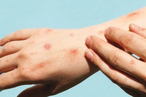 ¿Qué es la viruela del mono que la OMS declaró como emergencia global?