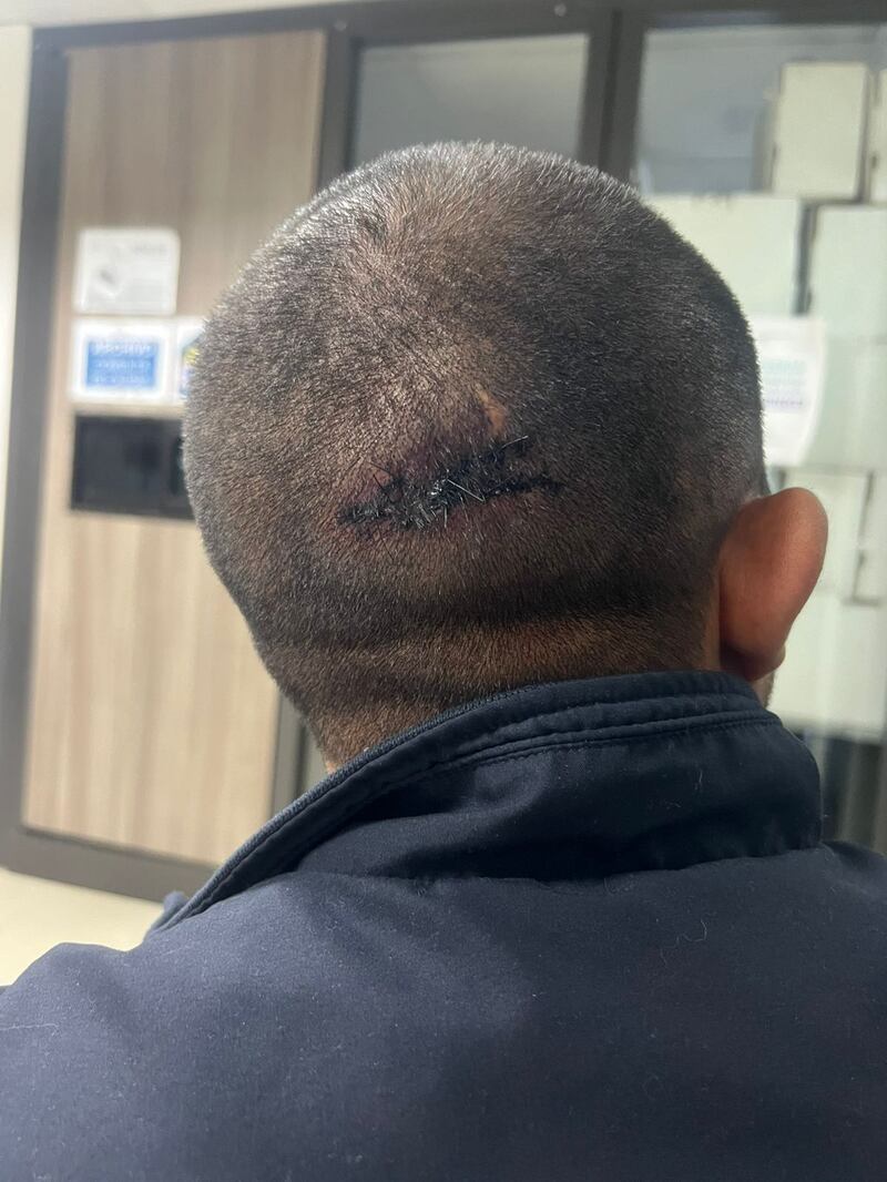Secuelas de las víctimas de abuso policial al norte de Quito
