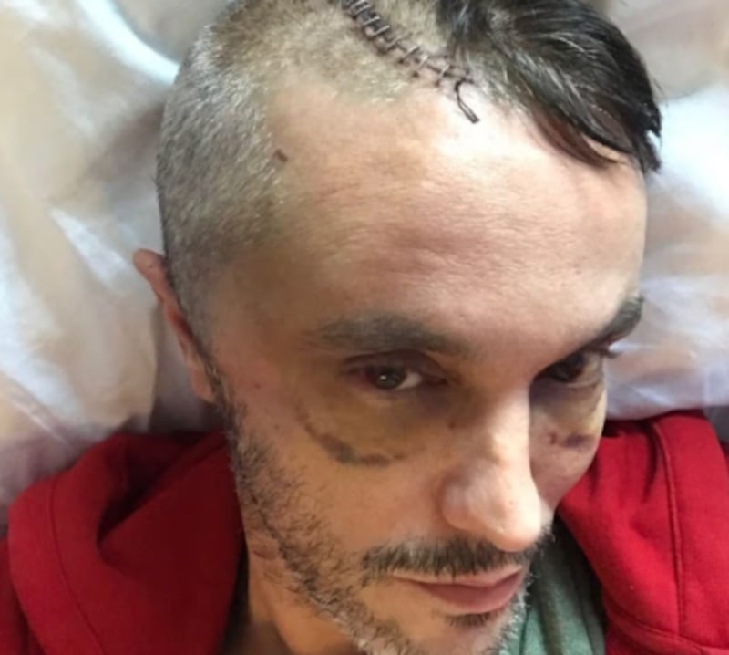 “Podía tocarme el cerebro”: hombre sufrió grave lesión en la cabeza tras caer por las escaleras - Fuente: Foto de la web
