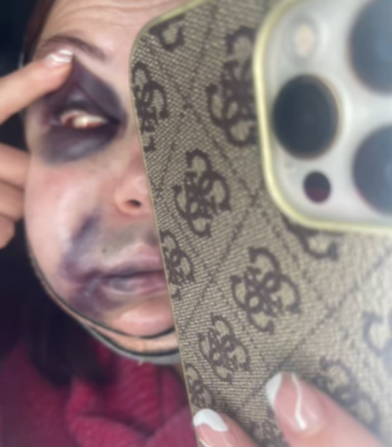 “Me desmayé del dolor”: así terminó el rostro de una mujer que se realizó una lipopapada en México - Fuente: Foto de la web